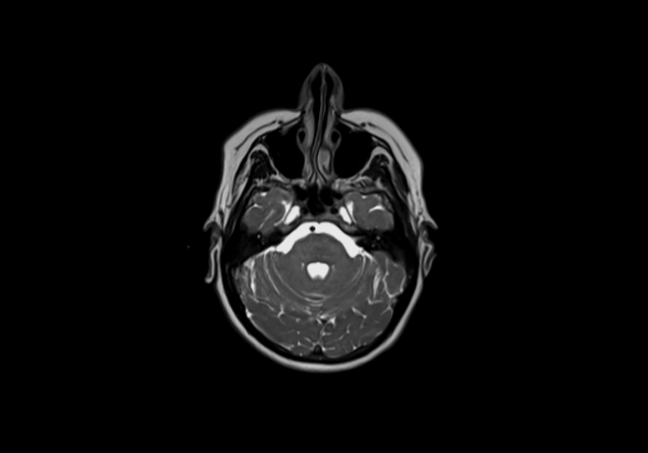 Neck axial  lymph node cross sectional MRI anatomy 3T MRI  image-img-00001-00013.webp
